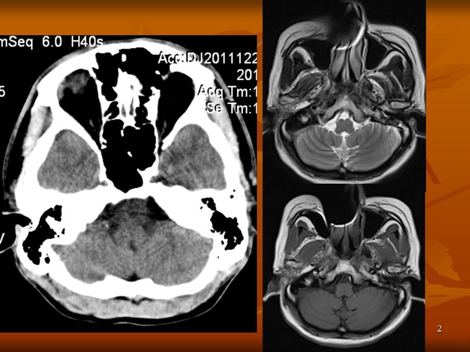 头颅CT、MRI疾病影像学课件.ppt_第2页