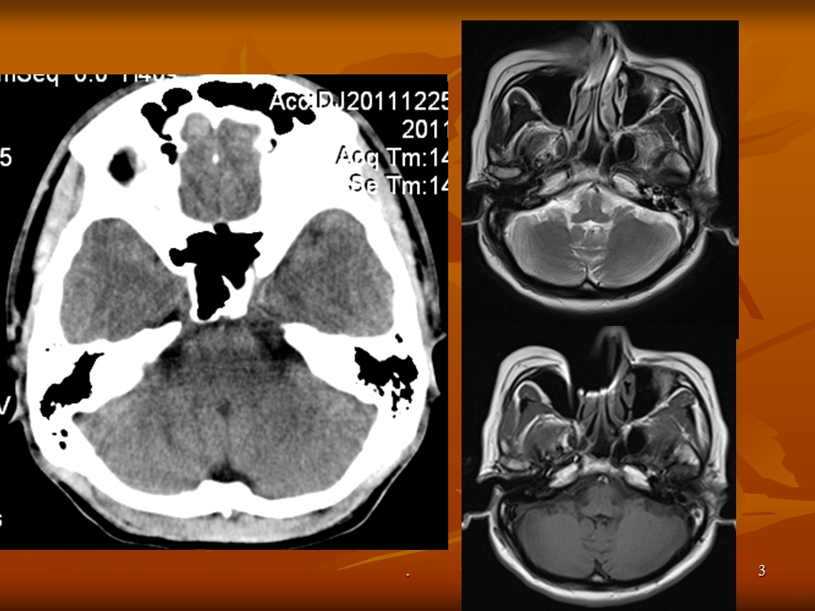 头颅CT、MRI疾病影像学课件.ppt_第3页