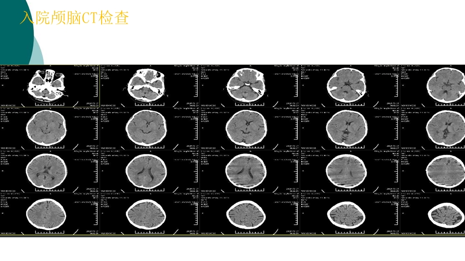 急性脑梗死动脉取栓治疗课件.ppt_第3页