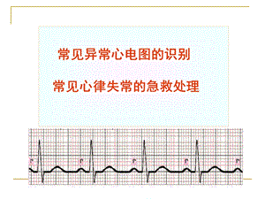 常见异常心电图的识别课件.ppt