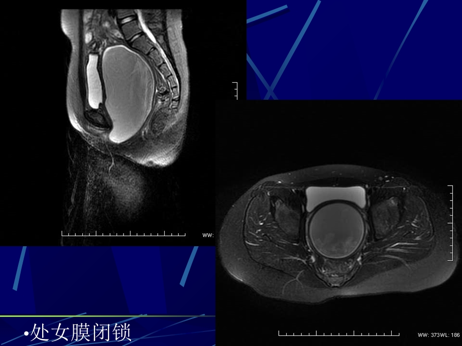 女性生殖系统畸形课件.ppt_第3页