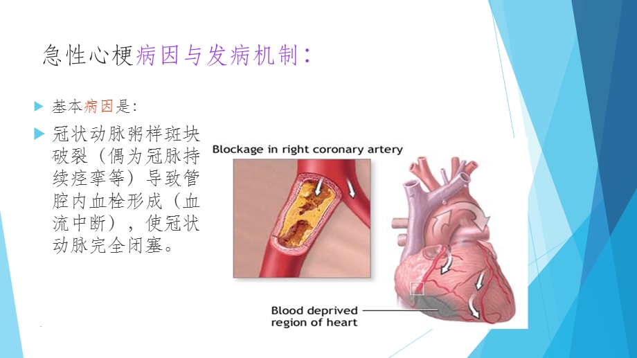 急性心梗溶栓的护理课件.ppt_第3页