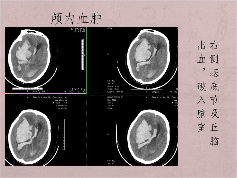 危急值放射科课件.ppt_第3页