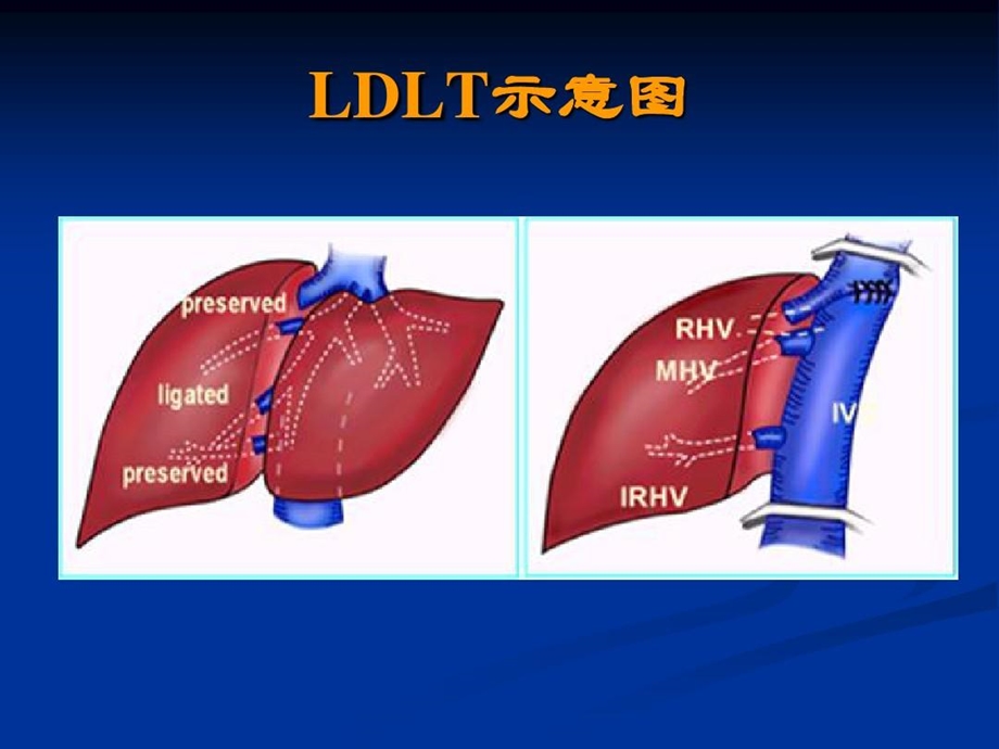 外科学总论之器官移植课件.ppt_第3页