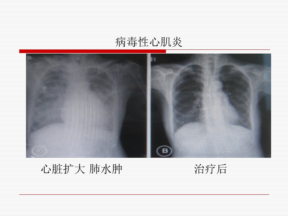 小儿暴发性心肌炎的诊断和治疗课件.ppt_第3页