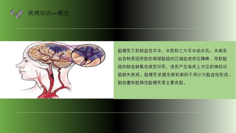 多发性脑梗死护理查房课件.ppt_第3页