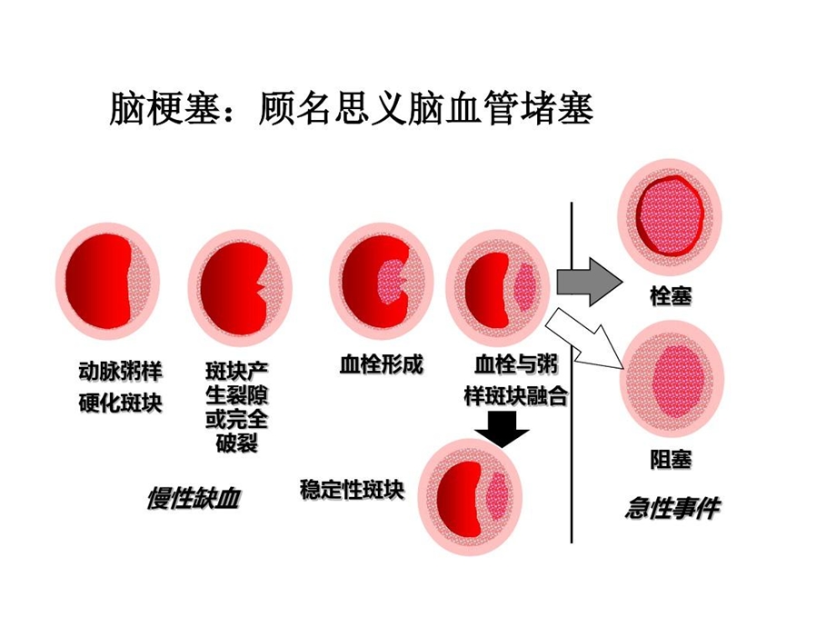 急性脑梗死rtPA溶栓治疗知识交流课件.ppt_第3页