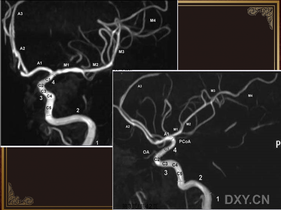 大脑中动脉课件.pptx_第3页