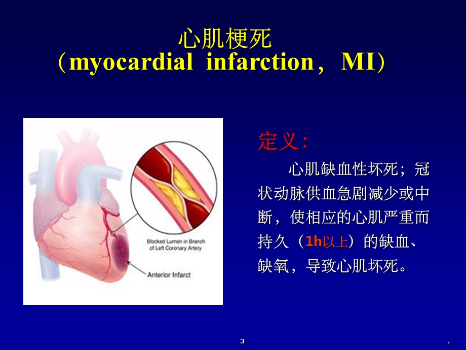 心肌梗死精课件.ppt_第3页