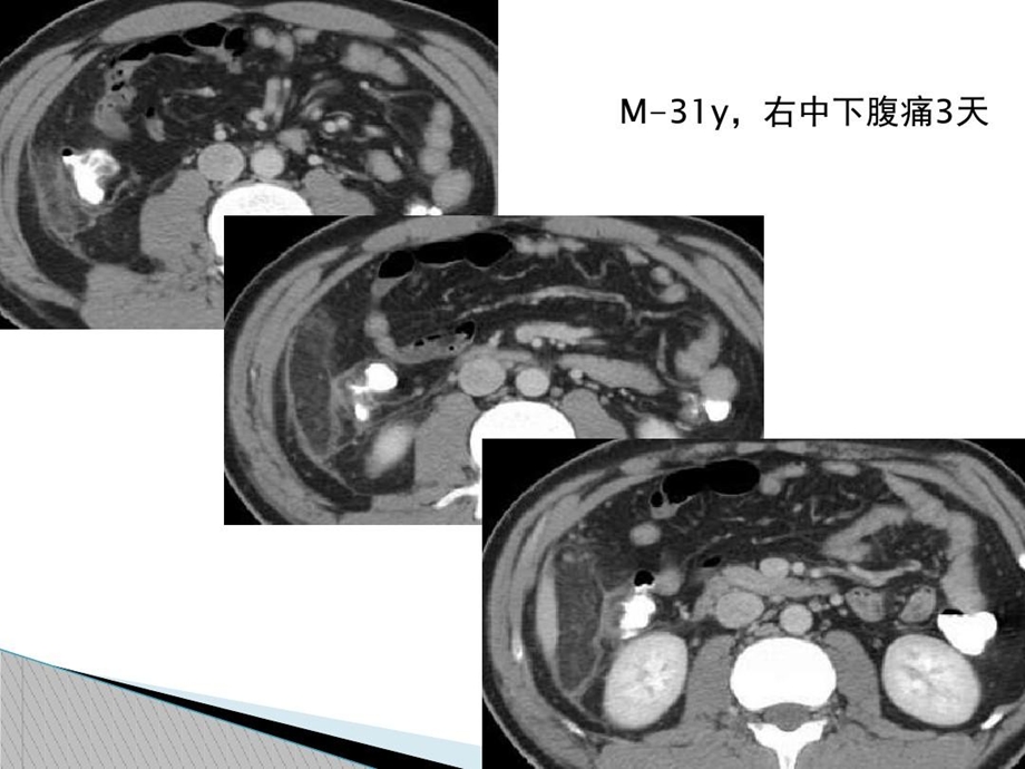 急性肠脂垂炎的CT诊断课件.ppt_第2页