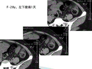 急性肠脂垂炎的CT诊断课件.ppt