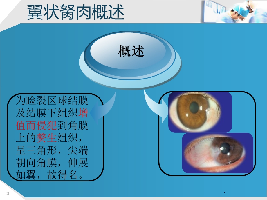 眼科翼状胬肉课件.ppt_第3页