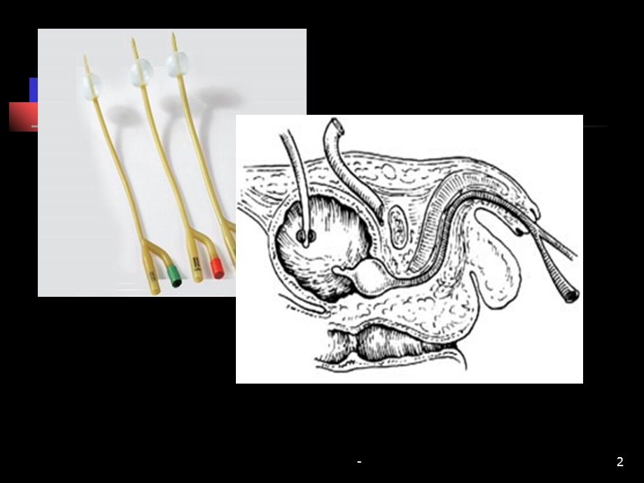 留置囊性尿管中课件.ppt_第2页