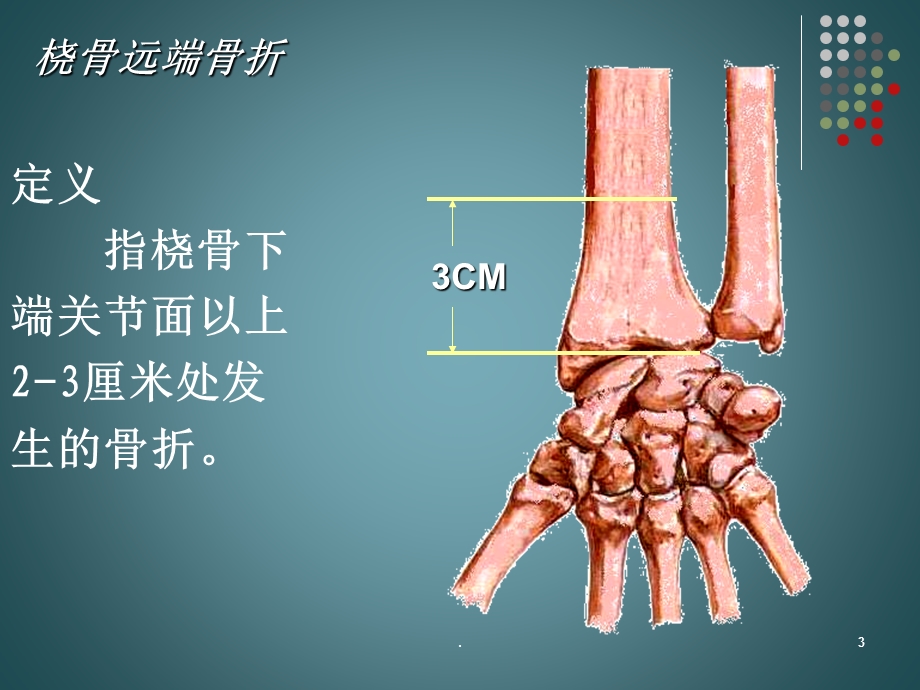 桡骨远端骨折的护理ppt课件.pptx_第3页