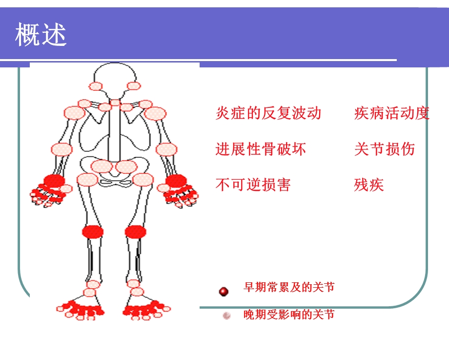 类风湿关节炎课件.ppt_第2页