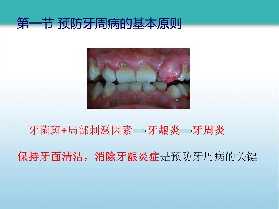牙周病的预防和疗效维护课件.pptx_第2页