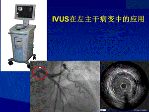 IVUS在左主干病变中的应用-课件.ppt