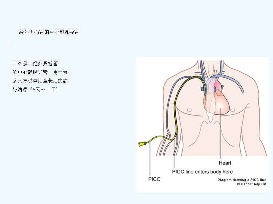 PICC置管护理及健课件.ppt_第3页