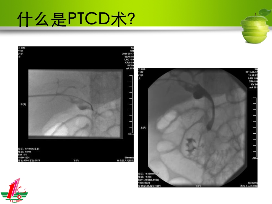 PTCD围手术期护理与观察课件.ppt_第3页