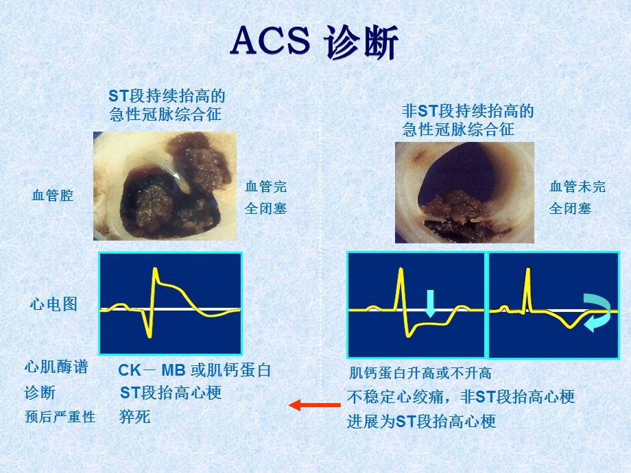 NSTEACS的诊断和治疗齐国先课件.ppt_第3页