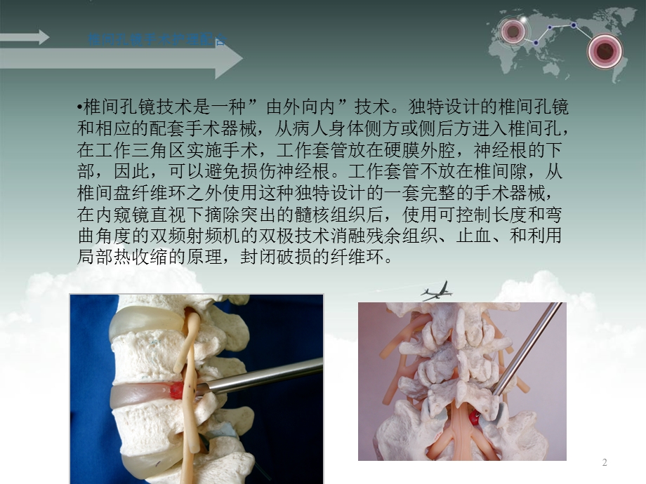 Joimax椎间孔镜手术护理配合课件.ppt_第2页