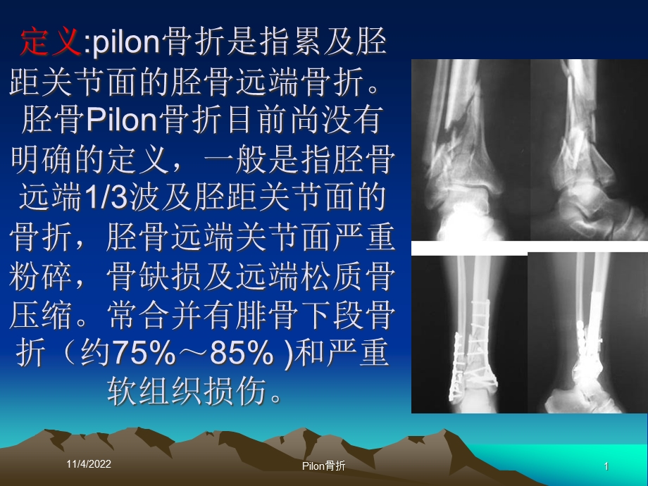 Pilon骨折培训课件.ppt_第1页