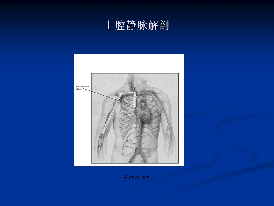 PICC管的X线定位学习教案课件.pptx_第2页