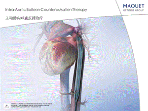 iabp操作(机器及植入)方法技巧课件.ppt