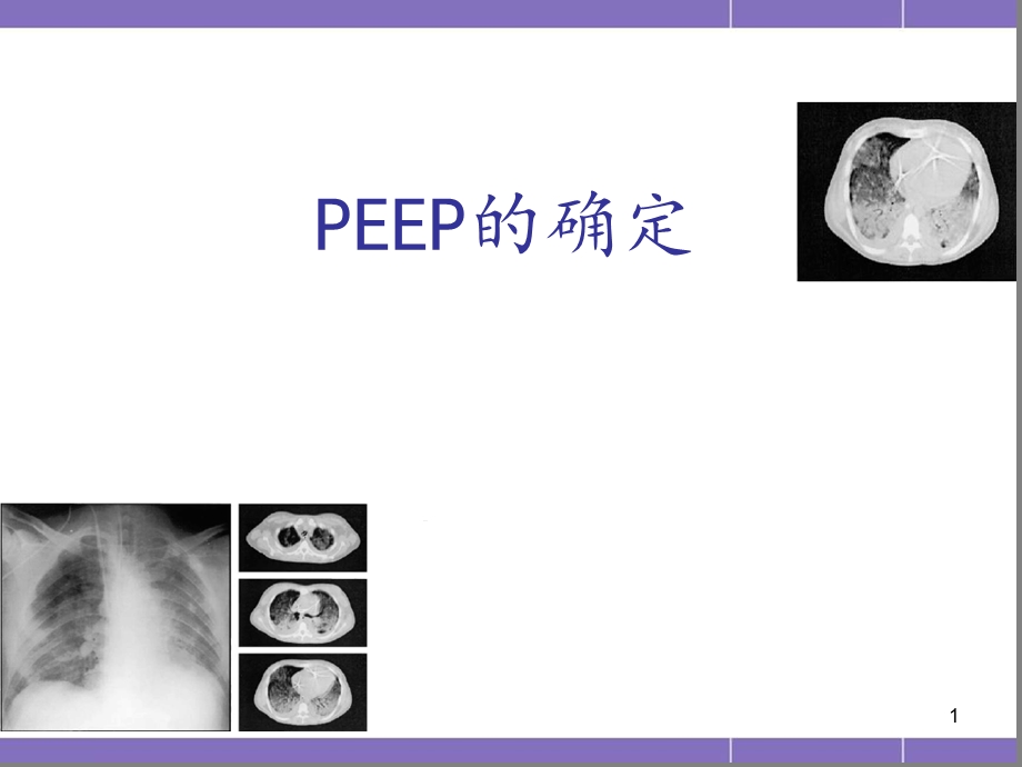 PEEP的滴定医学课件.ppt_第1页