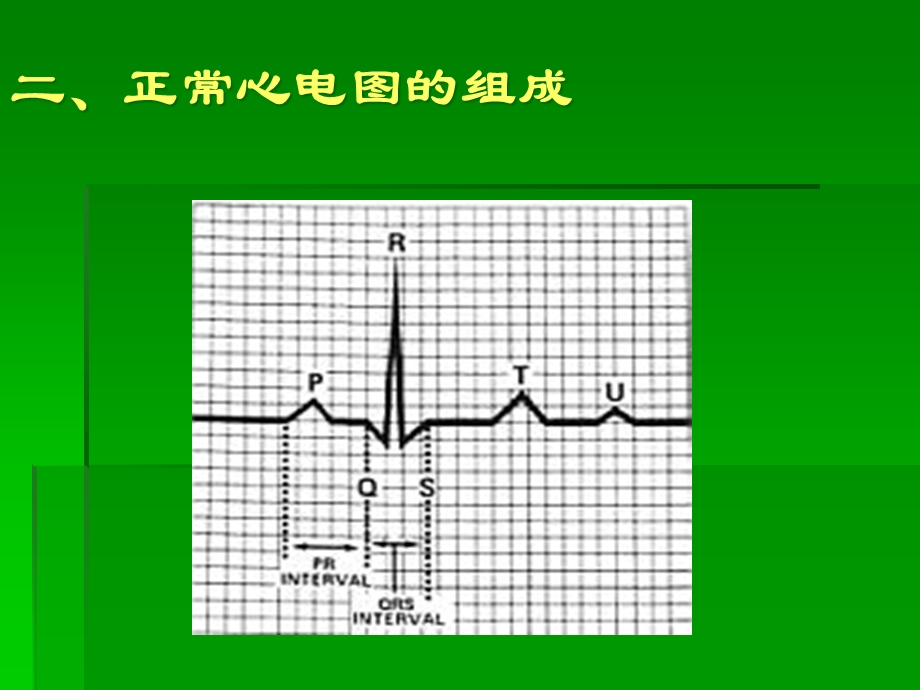 icu常见心电图知识-课件.ppt_第3页