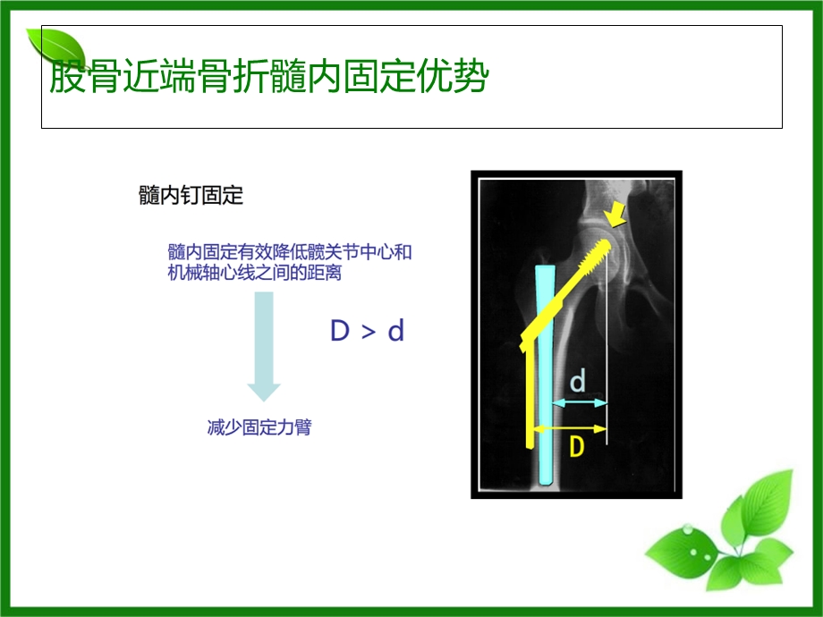 PFNA髓内钉在股骨近端骨折的应用课件.ppt_第3页