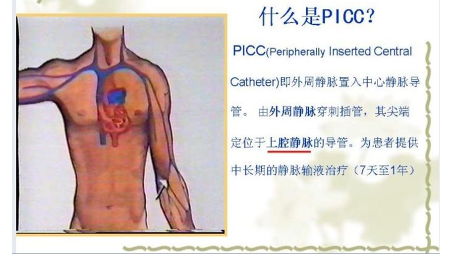 PICC管的置入流程课件.ppt_第2页