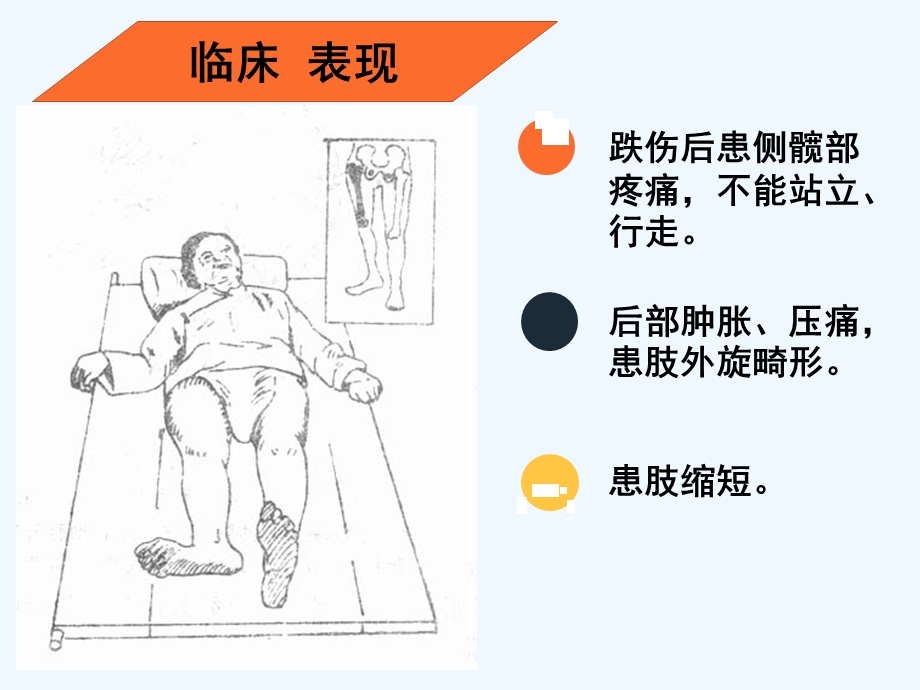 股骨颈骨折健康教育课件.ppt_第3页