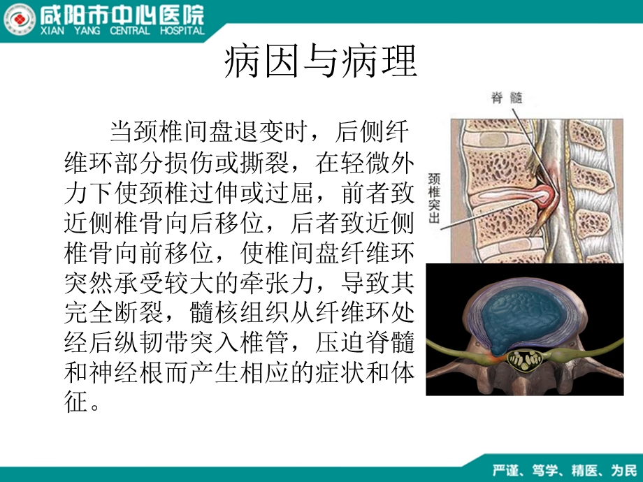 颈椎间盘突出症ppt课件.ppt_第3页