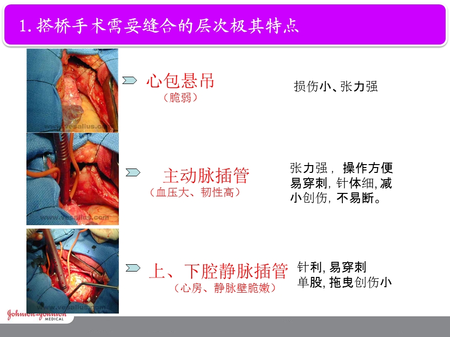 CV 搭桥对针线的选择课件.ppt_第3页