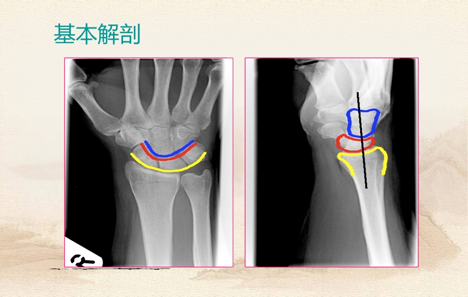 腕关节解剖及常见病变MRI表现课件.ppt_第3页