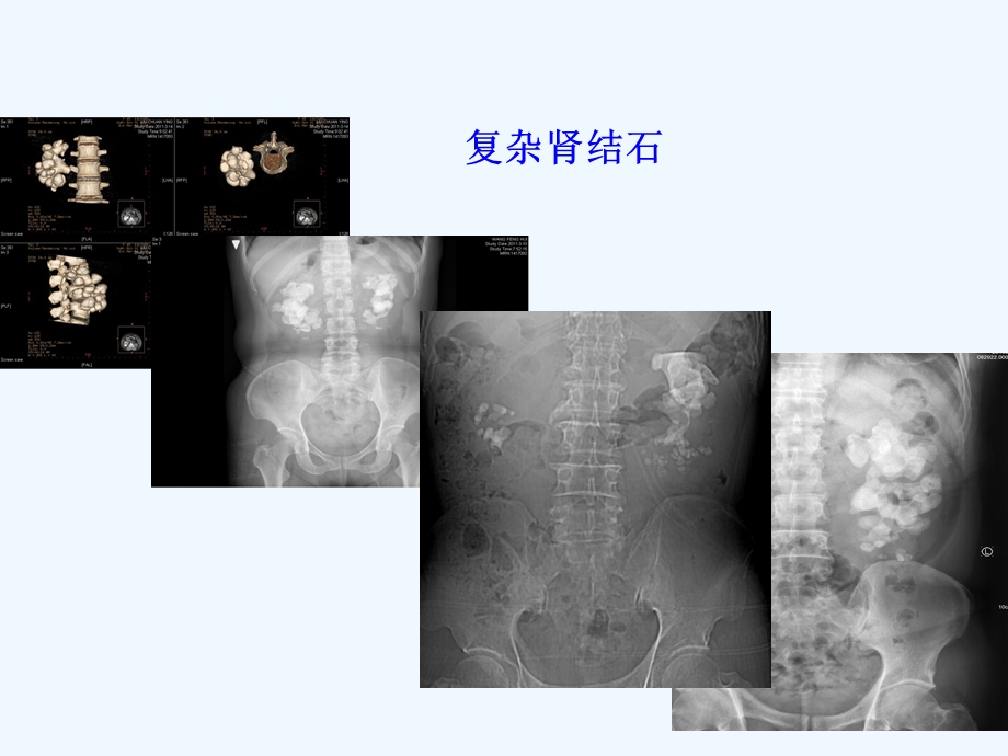 超声引导PCNL技术课件.ppt_第2页