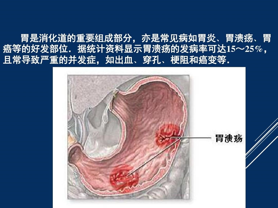 胃肠道间质瘤影像表现与诊治课件.ppt_第2页