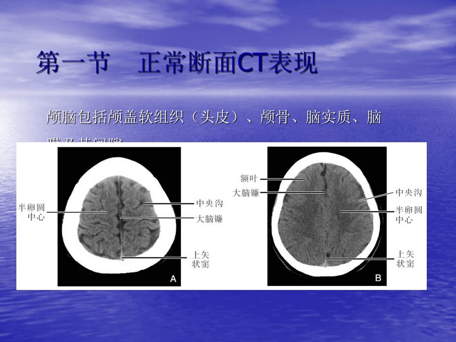 颅脑正常断面CT表现课件.ppt_第2页