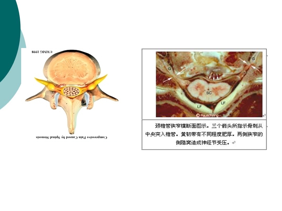 颈椎管狭窄症的诊断与治疗课件.ppt_第3页