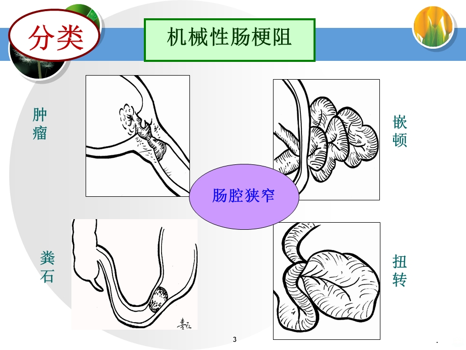 麻痹性肠梗阻查房课件.ppt_第3页