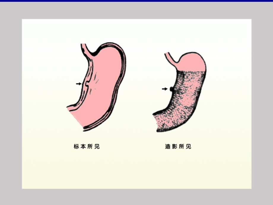 胃肠道异常X线表现课件.pptx_第2页