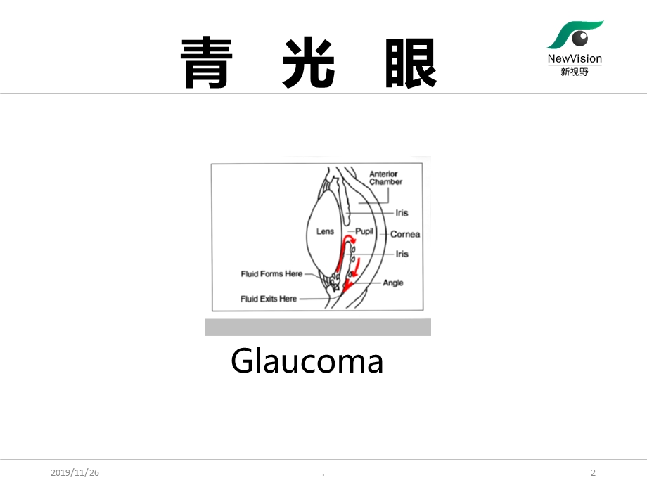 青光眼基础知识课件.ppt_第2页