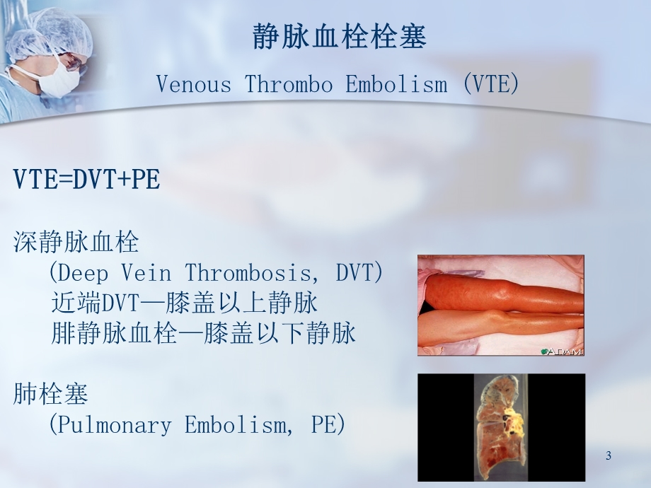 骨科深静脉血栓的预防课件.ppt_第3页