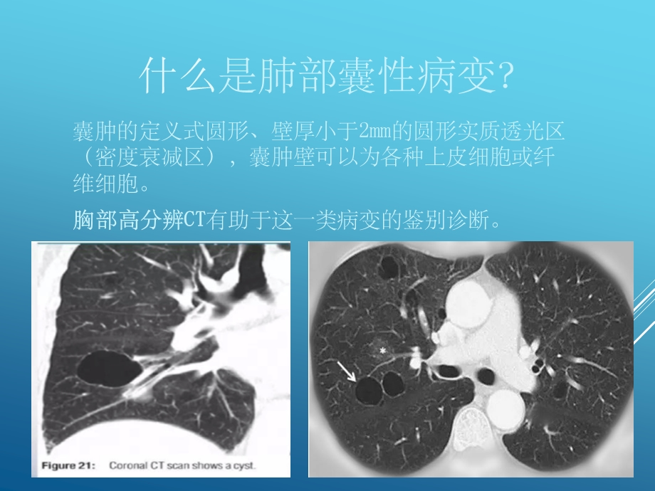 肺部囊性疾病课件.ppt_第2页