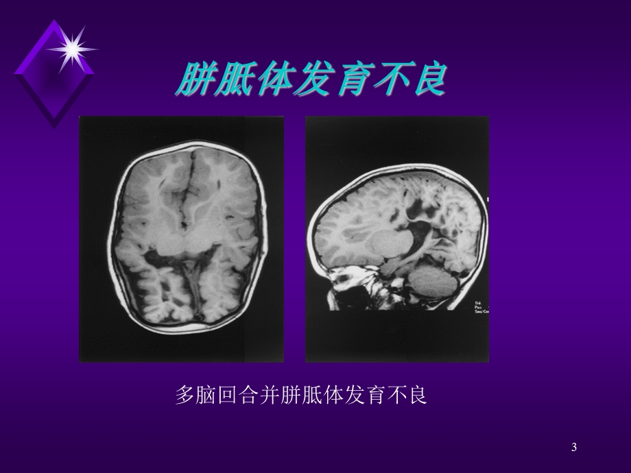 颅脑病变的MRI诊断课件.ppt_第3页