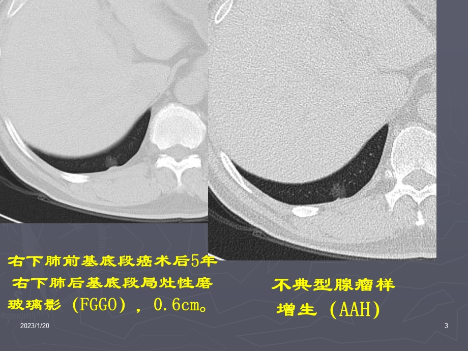 肺部结节的鉴别诊断资料课件.ppt_第3页