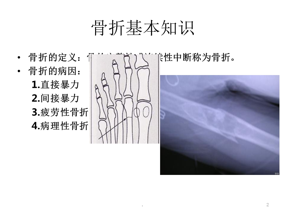 胫腓骨骨折课件.ppt_第2页