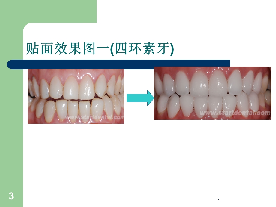 贴面研究课件.ppt_第3页