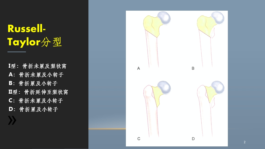 股骨粗隆下骨折课件.ppt_第2页